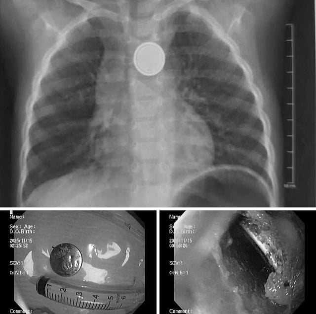 Seorang budak lelaki di Hai Phong mengalami ulser esofagus yang teruk akibat menelan bateri butang - Foto 1. Bé trai ở Hải Phòng bị loét thực quản nặng vì nuốt pin cúc áo- Ảnh 1.