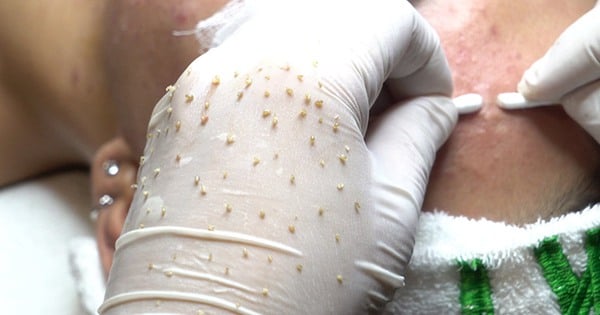 Nỗi đau không thể ngờ sau khi nhiễm H từ một lần làm đẹp tại spa