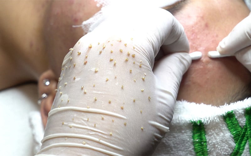 Nỗi đau không thể ngờ sau khi nhiễm H từ một lần làm đẹp tại spa- Ảnh 2.