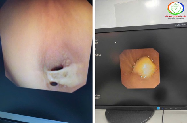 Nhiều trẻ bị tổn thương đường thở do hóc dị vật- Ảnh 2.