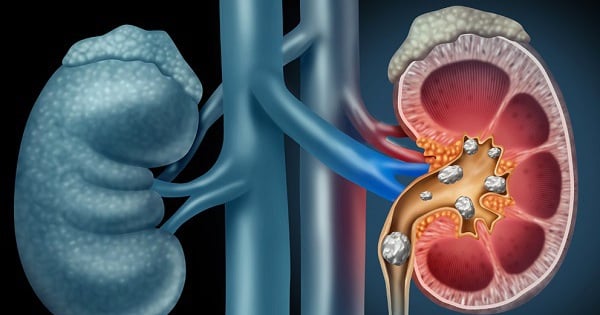 Cách điều trị bệnh sỏi thận đúng cần biết