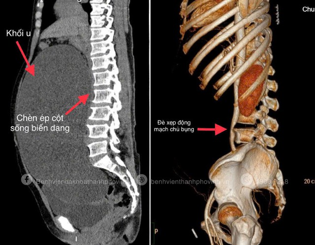 Hình ảnh khối u nang buồng trứng khổng lồ chiếm trọn ổ bụng, chèn ép gây xẹp động mạch chủ bụng, các cơ quan bị đẩy lệch vị trí, niệu quản bị ép gây giãn đài bể thận hai bên.