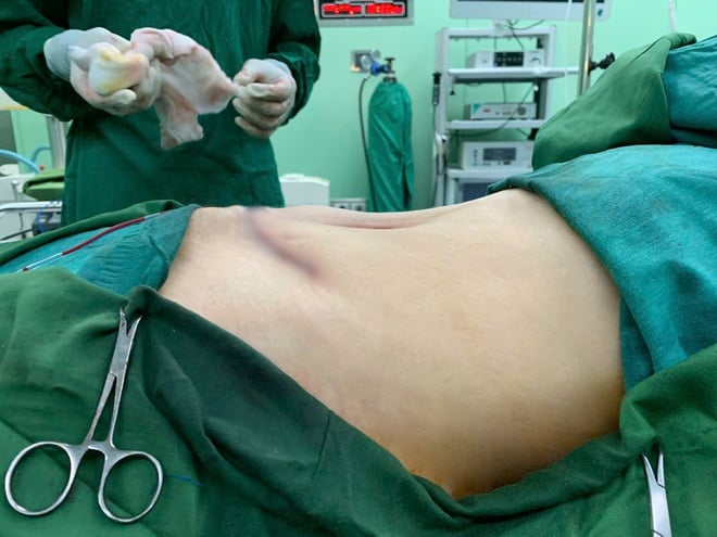 Phẫu thuật khối u nang buồng trứng nặng 6kg cho người phụ nữ 56 tuổi- Ảnh 5.