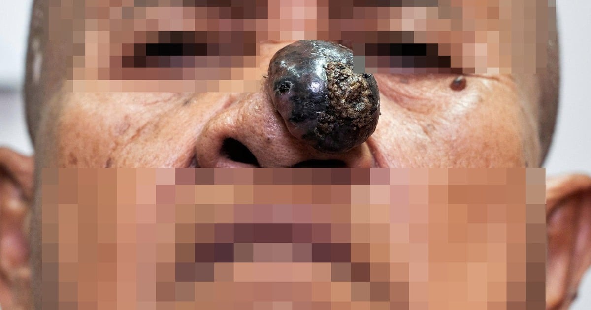 Cụ bà mang khối u đầu mũi hoại tử, chảy máu liên tục