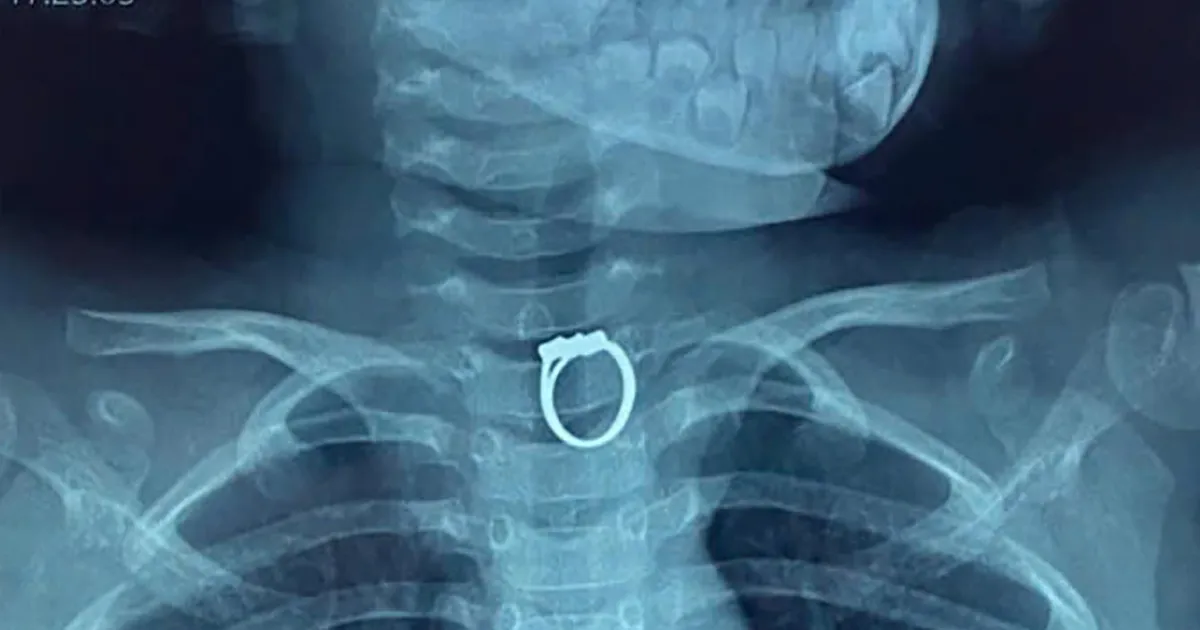 Nội soi gắp chiếc nhẫn ra khỏi thực quản bé gái 5 tuổi