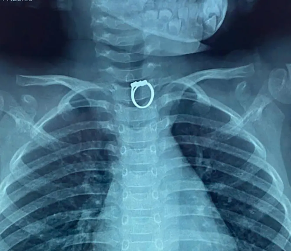 এক্স-রেতে দেখা গেল শিশুকন্যার খাদ্যনালীতে আটকে থাকা আংটি