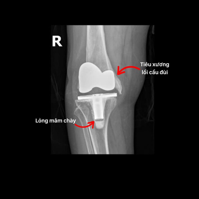 Khó khăn và thách thức trong phẫu thuật thay lại khớp gối- Ảnh 3.
