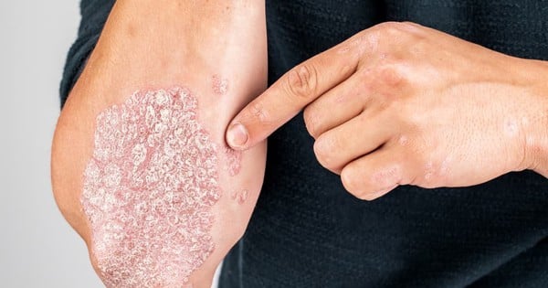 Bệnh vảy nến: dấu hiệu nhận biết và những ai có nguy cơ cao?