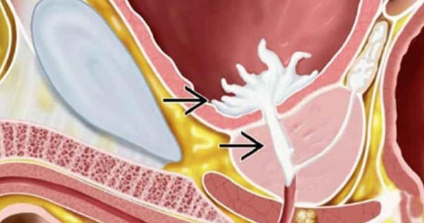Không thấy tinh dịch sau quan hệ cảnh báo xuất tinh ngược
