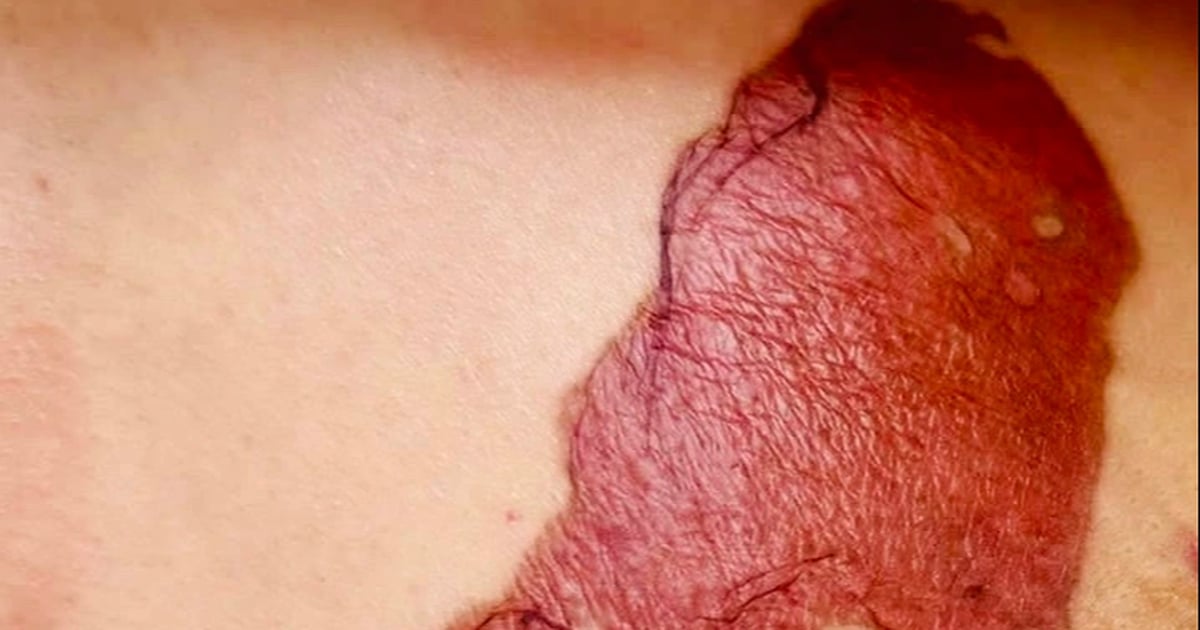 Dán cao trị u vú khiến da phồng rộp, đi khám phát hiện ung thư