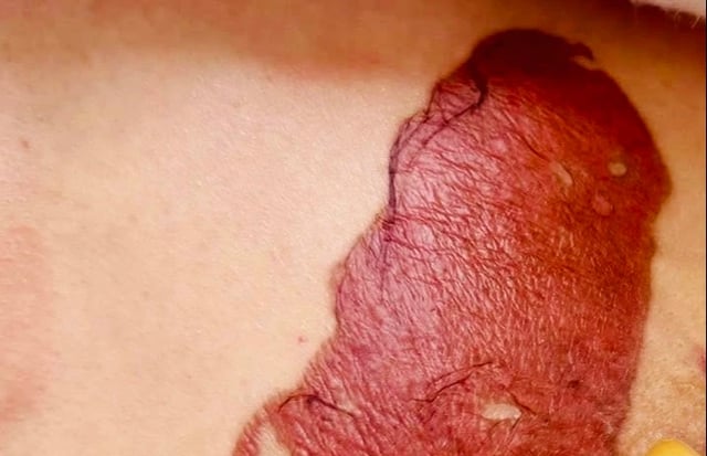 Dán cao trị u vú, đi khám phát hiện ung thư - Ảnh 1.