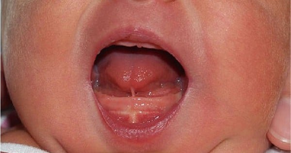Dấu hiệu nhận biết sớm trẻ dính thắng lưỡi và thời điểm can thiệp