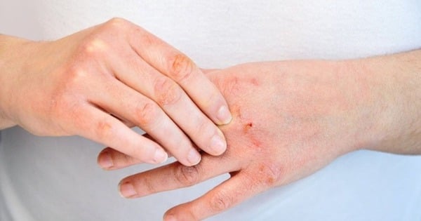 Sai lầm phổ biến khiến da bong tróc và nứt nẻ khi dùng máy sưởi mùa lạnh