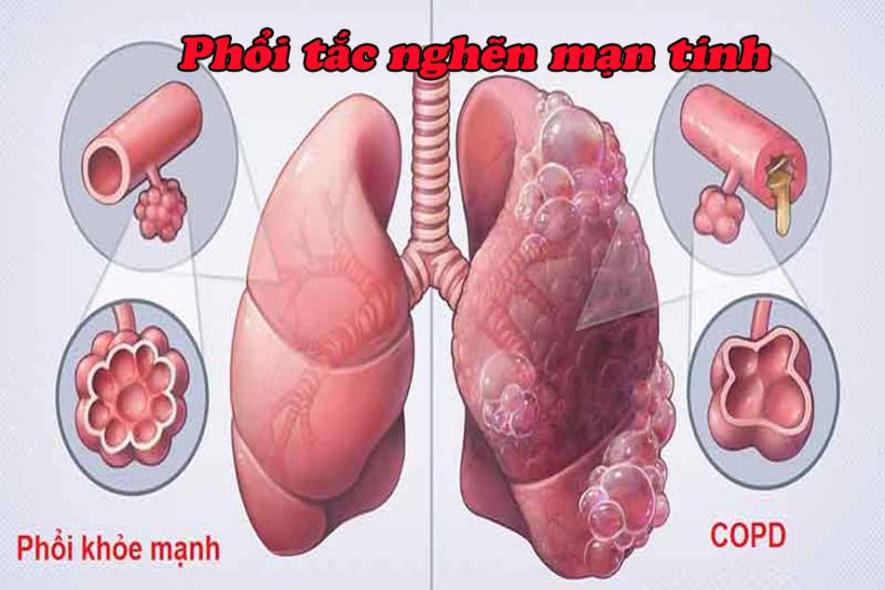 การวินิจฉัยโรคปอดอุดกั้นเรื้อรัง (COPD) - ภาพที่ 1