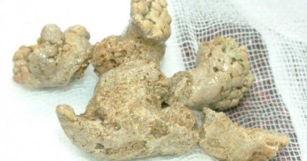 Sỏi san hô trong thận là gì, có nguy hiểm không?