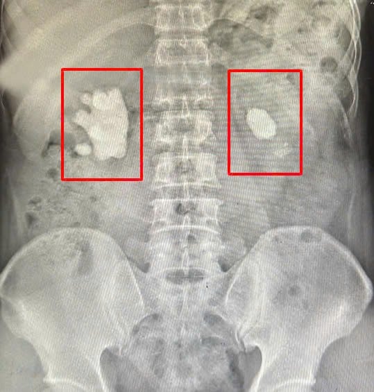 Sỏi san hô trong thận là gì, có nguy hiểm không?- Ảnh 1.