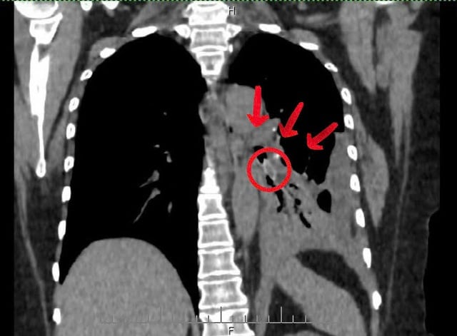 Hai bệnh nhân thoát nguy kịch nhờ gắp dị vật đường thở kịp thời- Ảnh 2.