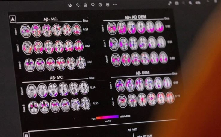 Hãng dược Novo Nordisk thất bại trong thử nghiệm thuốc điều trị Alzheimer