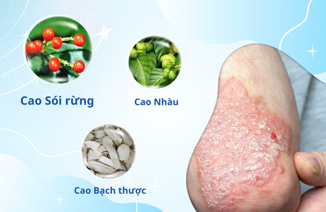 Kiểm soát vảy nến thế nào để hạn chế tái phát vào mùa đông khô lạnh?- Ảnh 2.