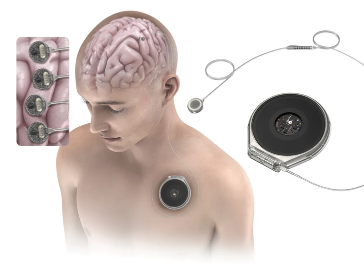 cấy chip - Ảnh 2.