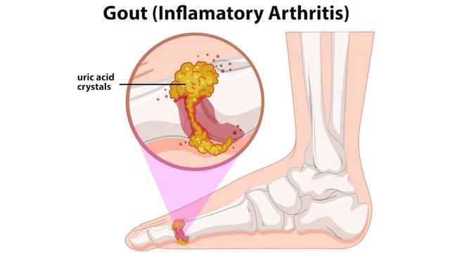 Cách dùng củ ráy hỗ trợ hạ axit uric - Ảnh 1.