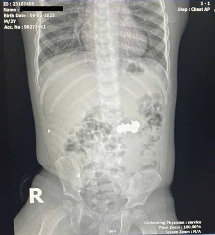 Bé trai nuốt 4 viên đinh nam châm đầu nhọn nguy hiểm
- Ảnh 1.