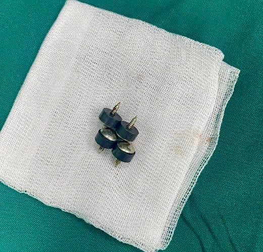 Bé trai nuốt 4 viên đinh nam châm đầu nhọn nguy hiểm
- Ảnh 2.