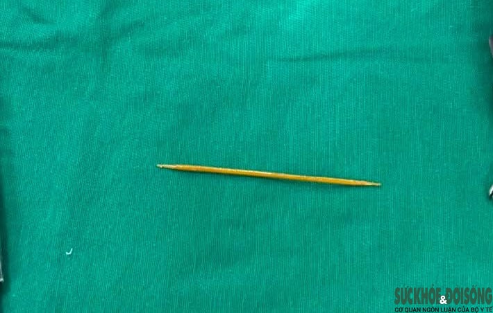 Người phụ nữ 66 tuổi thủng đại tràng vì ngậm tăm khi ngủ- Ảnh 2.