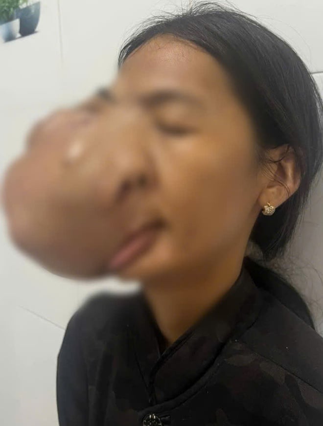 Giải cứu khuôn mặt biến dạng 10 năm vì khối u men răng khổng lồ- Ảnh 1.