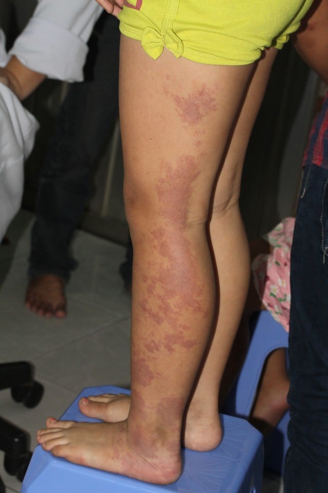 Bị 'bớt đỏ rượu vang' có nên điều trị? - Ảnh 1.