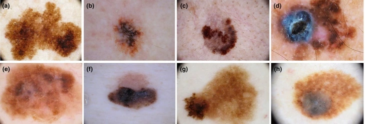 Tompok hitam pada kulit, apabila sikat adalah tanda kanser kulit - Foto 1. Đốm đen trên da, khi nào là dấu hiệu của ung thư da? - Ảnh 1.