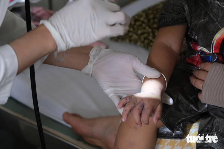 tay chân miệng - Ảnh 1.