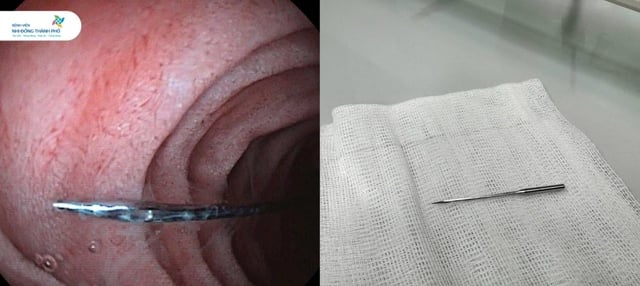 Bé trai 11 tuổi suýt mất mạng vì nuốt kim may đồ dài 4cm- Ảnh 1.