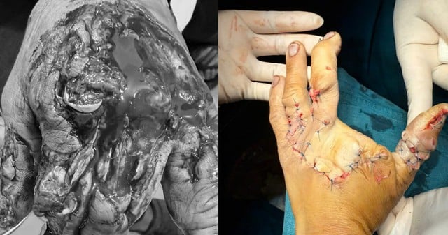 Dập nát bàn tay vì máy băm sắn- Ảnh 1.