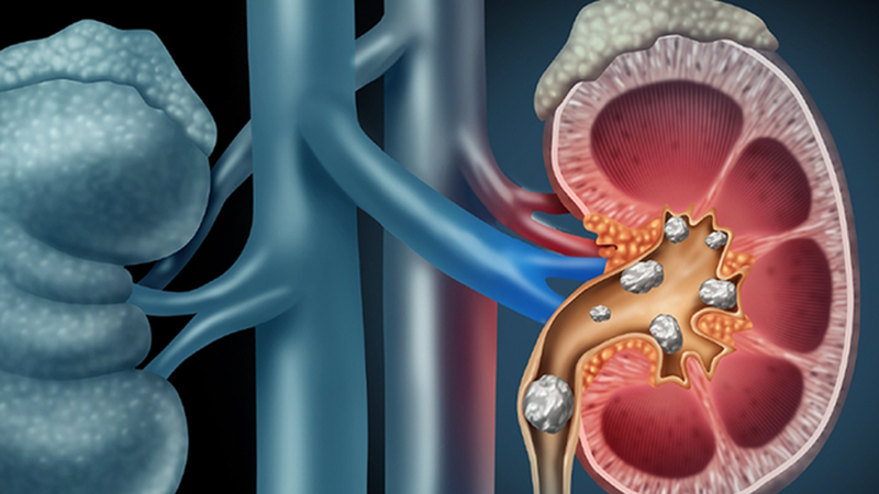 Đau lưng, tiểu són đề phòng sỏi thận- Ảnh 1.