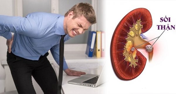 Đau lưng, tiểu són đề phòng sỏi thận- Ảnh 2.