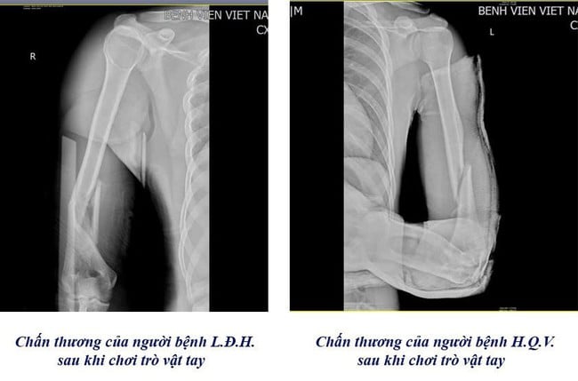 Cảnh báo nguy cơ gẫy xương cánh tay từ trò vật tay- Ảnh 1.