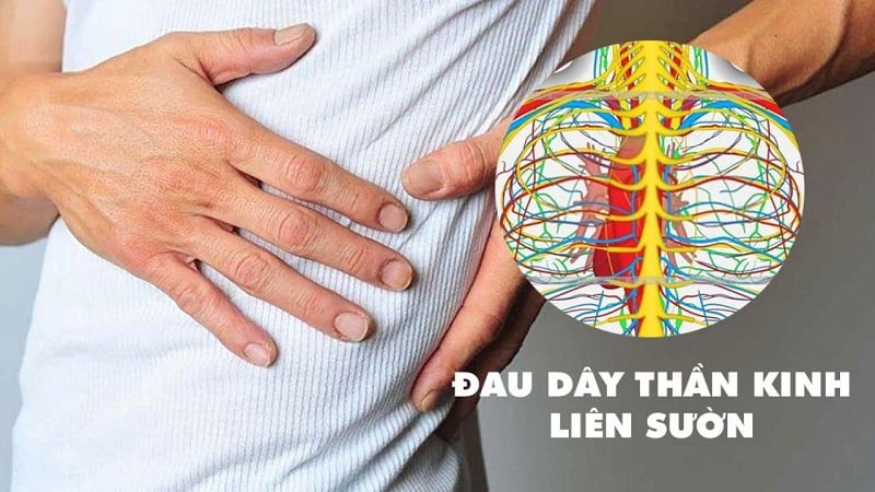 Ai có nguy cơ bị đau dây thần kinh liên sườn?- Ảnh 1.