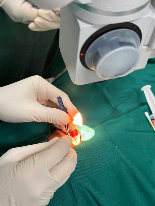 Chuyển giao kỹ thuật mổ mộng mắt giúp người dân vùng biên được điều trị ngay tại cơ sở- Ảnh 2.