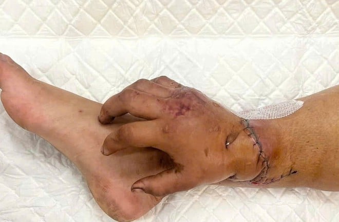 ທ່ານໝໍ Vo Thai Trung, ໂຮງໝໍທົ່ວໄປ ບິ່ງເຢືອງ, ເລົ່າເລື່ອງການຜ່າຕັດປ່ຽນມືຫາຂາຊົ່ວຄາວທີ່ຫາຍາກ, ຊ່ວຍຊີວິດແມ່ ແລະລູກໃນທ້ອງ - ຮູບ 2. Bác sĩ Võ Thái Trung, BVĐK Bình Dương kể về ca ghép tạm bàn tay vào chân hiếm gặp, cứu mẹ và hai thai nhi- Ảnh 2.