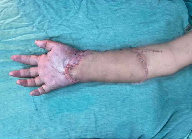 ທ່ານໝໍ Vo Thai Trung, ໂຮງໝໍທົ່ວໄປ ບິ່ງເຢືອງ, ເລົ່າເລື່ອງການປ່ຽນມືຫາຂາຊົ່ວຄາວທີ່ຫາຍາກ, ຊ່ວຍຊີວິດແມ່ ແລະລູກໃນທ້ອງ 2 ຄົນ - ພາບ 3. Bác sĩ Võ Thái Trung, BVĐK Bình Dương kể về ca ghép tạm bàn tay vào chân hiếm gặp, cứu mẹ và hai thai nhi- Ảnh 3.