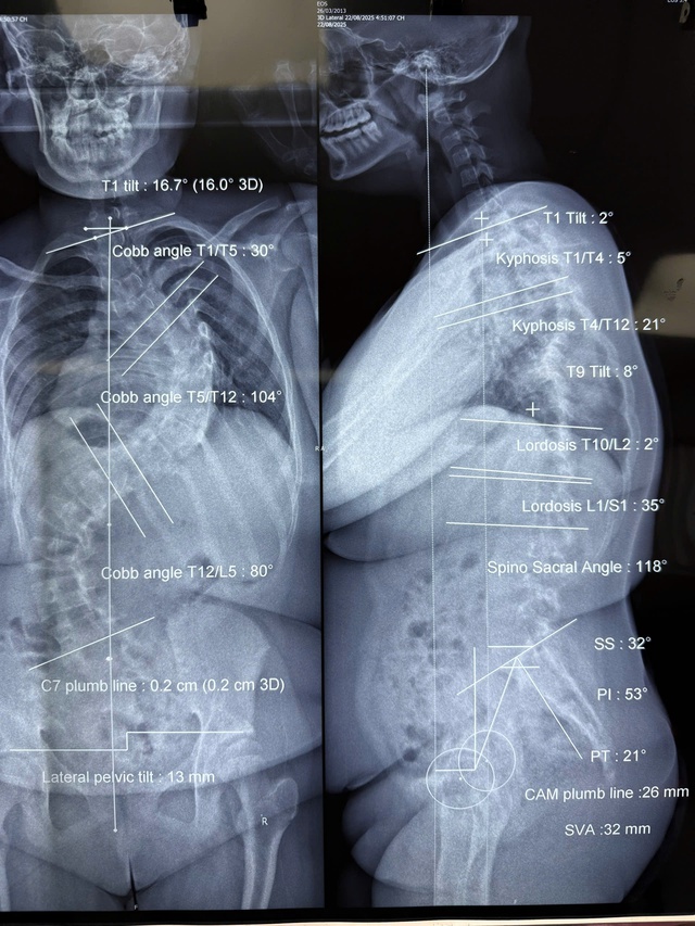 দুই মেয়ের 'ডাইনোসরের মেরুদণ্ড' সোজা করার যাত্রা - ছবি ২। Hành trình nắn lại 'xương sống khủng long' cho hai bé gái- Ảnh 2.