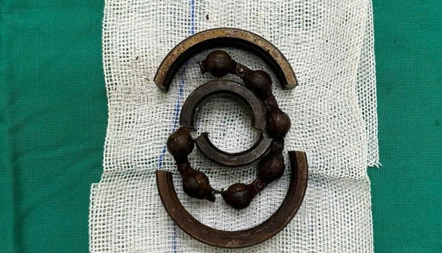 Лікарі використовують пилку, щоб розрізати срібне кільце, щоб звільнити застряглий пеніс - Фото 1. Bác sĩ dùng máy cưa cắt vòng bạc giải cứu 'cậu nhỏ' bị mắc kẹt- Ảnh 1.