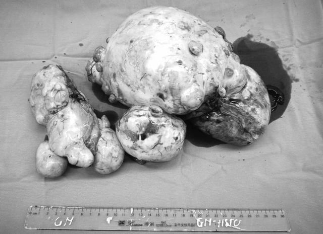 Bất ngờ phát hiện u buồng trứng sau chấn thương sọ não- Ảnh 2.