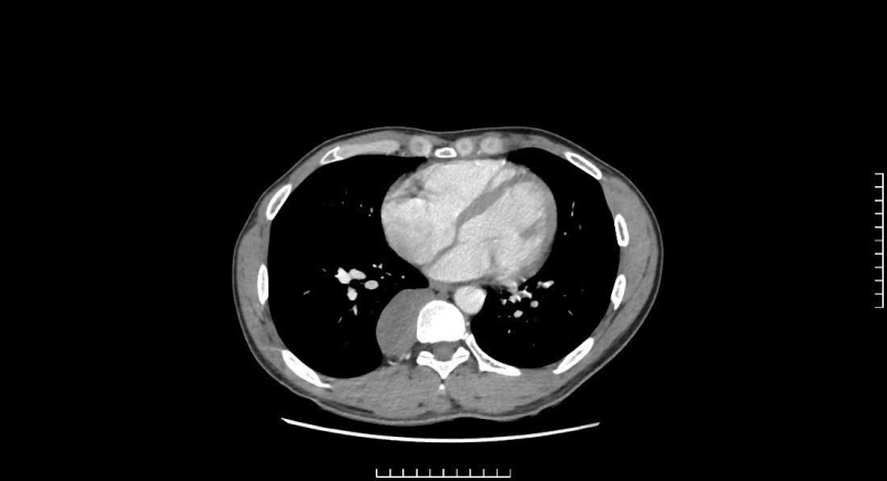 Nam thanh niên có khối u trung thất sau, biến chứng nguy hiểm - Ảnh 1.