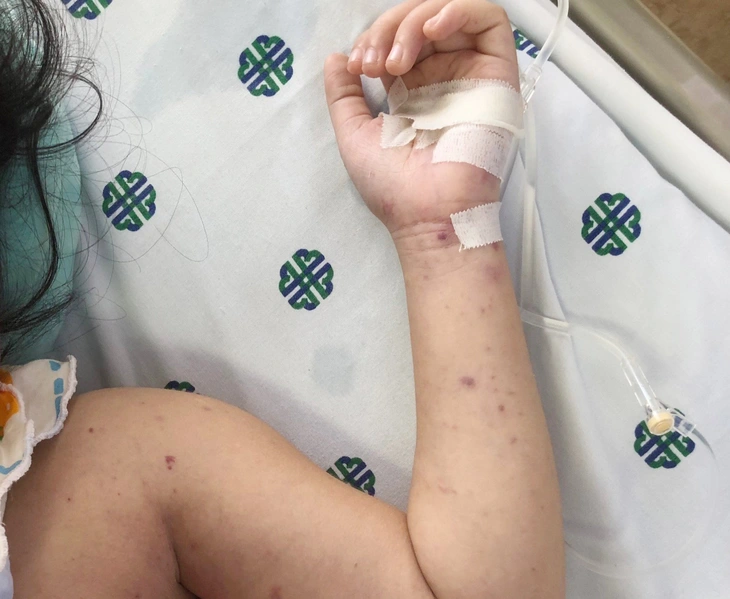 Meningite meningococcica - Immagine 1.