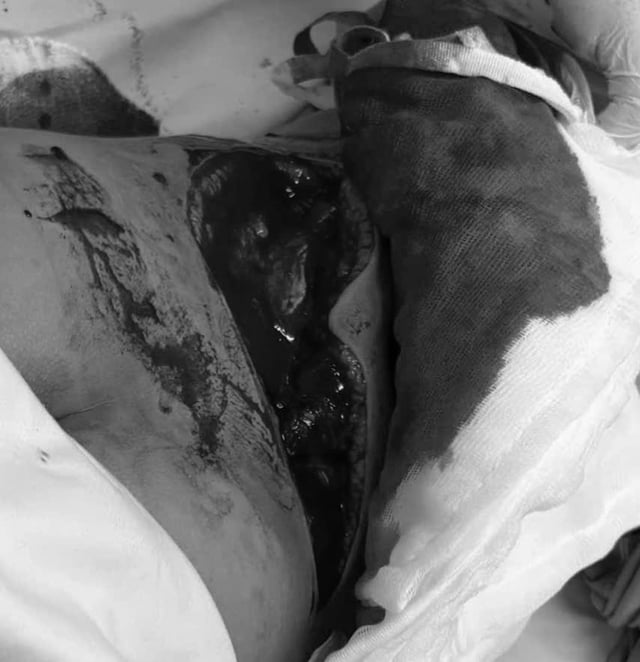 El inodoro se rompió de repente cuando se puso de pie, un niño de 8 años sufrió un desgarro de 25 cm en la espalda - Foto 1. Bồn cầu bất ngờ vỡ khi đứng lên, bé trai 8 tuổi bị rách 25 cm lưng- Ảnh 1.