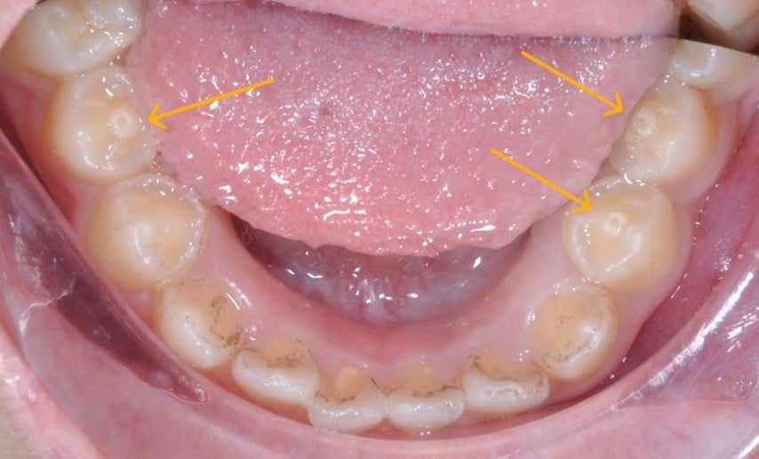 Túlzott rügyekkel rendelkező fogak – szövődmények kockázata, ha nem kezelik azonnal - 1. kép. Răng có núm phụ – nguy cơ biến chứng nếu không điều trị kịp thời- Ảnh 1.