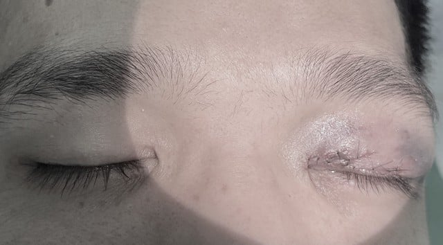 Mắt dập nát do tai nạn lao động, bệnh nhân được cứu thoát nguy cơ mất thị lực- Ảnh 1.