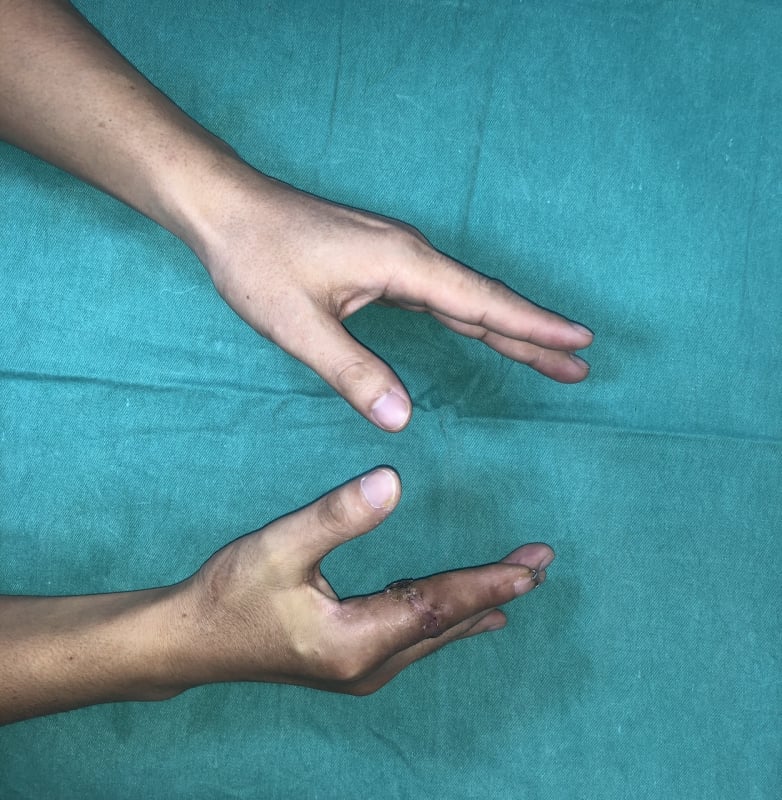 ملاح کی کٹی ہوئی انگلی حادثے کے 25 گھنٹے بعد دوبارہ جوڑی گئی -0